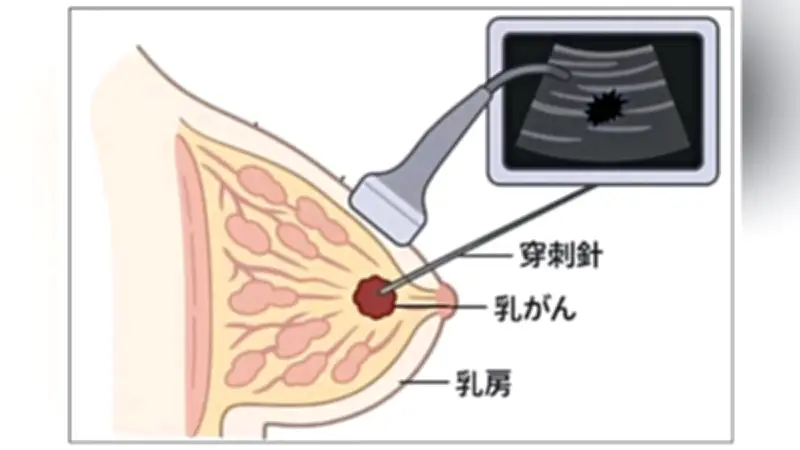 徳島大病院が乳がん新治療RFAを導入　早期発見で乳房温存の選択肢拡大
