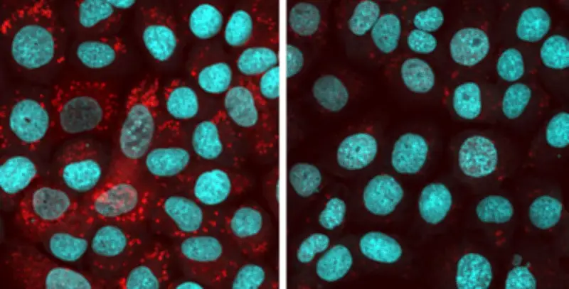 ALS治療に新たな光、タンパク質凝集体を抑制する化合物を発見 奈良県立医大など