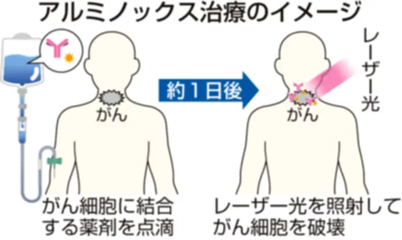 福島県で初の保険診療「アルミノックス治療」実施、切除不能な頭頸部がんに新たな選択肢