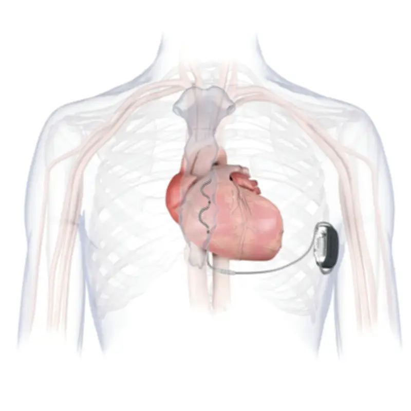 群馬大医学部付属病院が県内初の新型植え込み型除細動器手術に成功、小児にも適応可能に