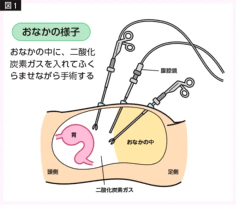 高齢者も安心！腹腔鏡手術の特徴と最新医療の進歩を外科医が解説