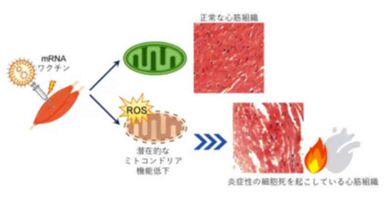 新型コロナワクチン副反応の心筋炎、ミトコンドリア機能低下が原因と解明